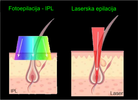Laseri.png